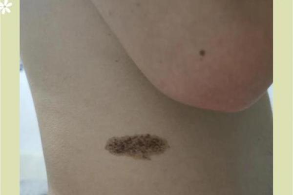 看胎记颜色类型算命