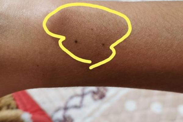 风水学上胎记中的有说明什么 风水学上胎记中的有说明什么