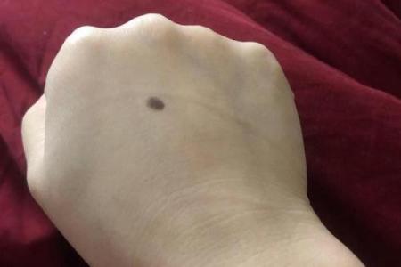 风水学上胎记中的有说明什么