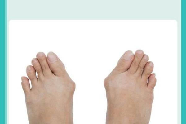 纠正外八字脚 纠正外八字脚