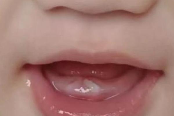 八字牙图片 八字牙图片