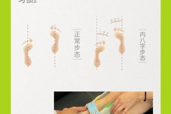 如何矫正外八字 如何矫正外八字