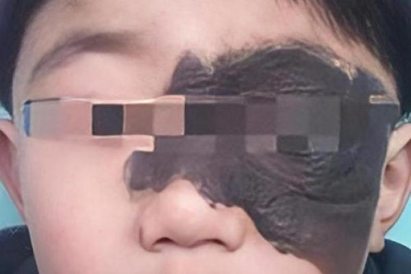 面部胎记算命 面部胎记算命