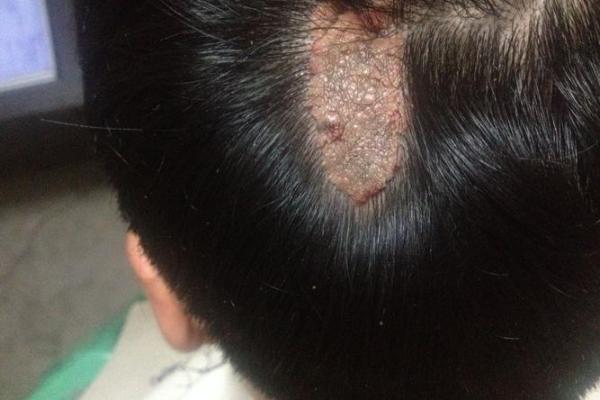 人体胎记算命的解释分析