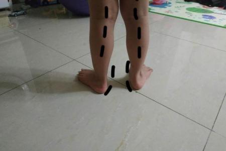 内八字和外八字