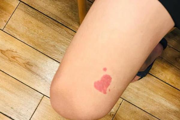 后背胎记算命 后背胎记算命