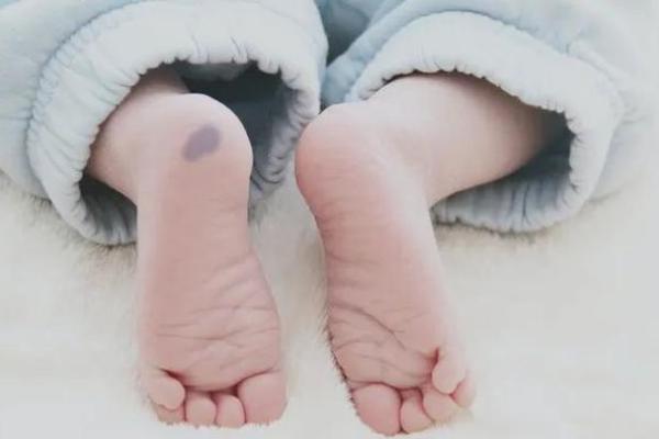 胎记位置算命看运势