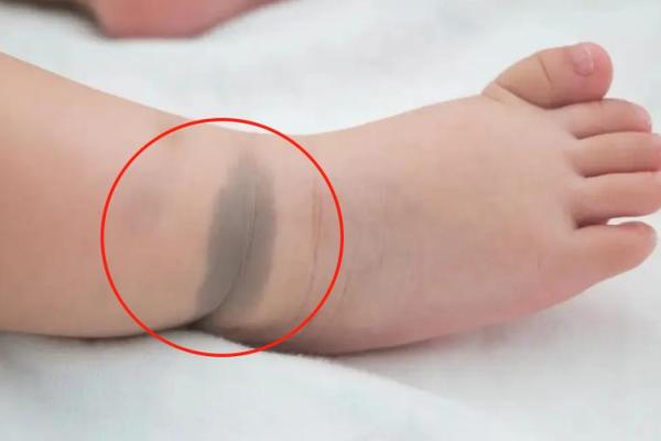 胎记位置算命看运势