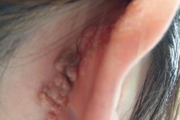 耳朵上的胎记算命分析