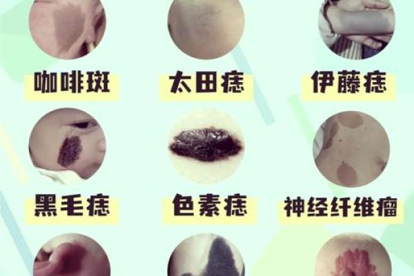 耳朵上的胎记算命分析