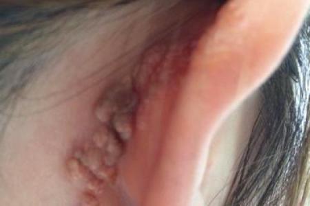 耳朵上的胎记算命分析