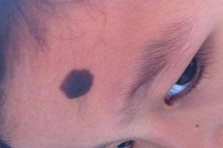 面部上的胎记算命分析