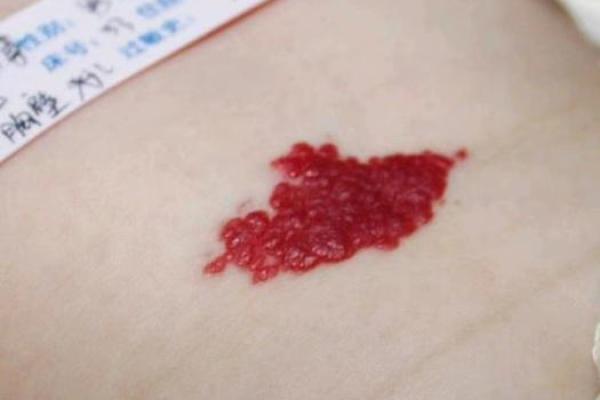 红色的胎记算命