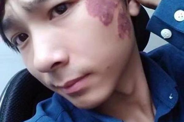 面部不同位置的胎记算命