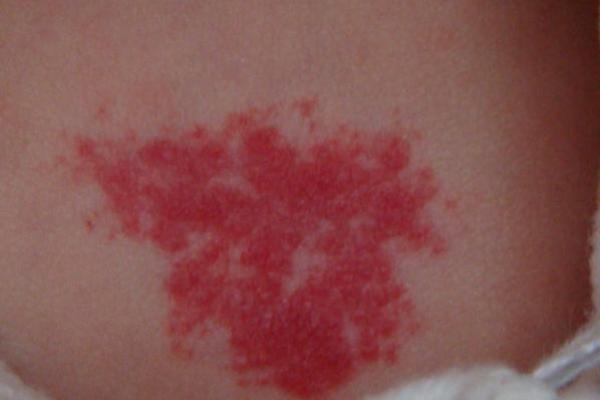 红色的胎记如何看相算命-