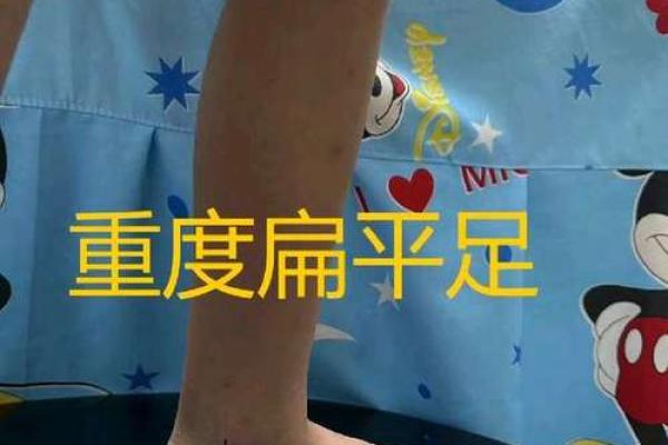 儿童内八字脚 儿童内八字脚