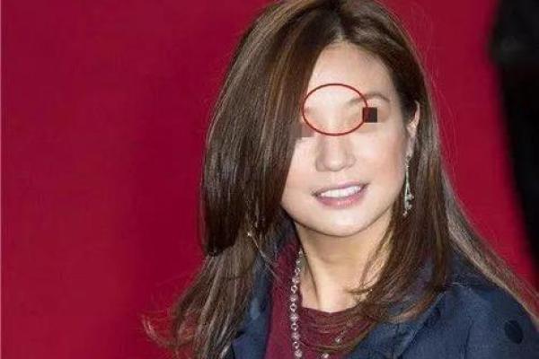 红色胎记算命看危害