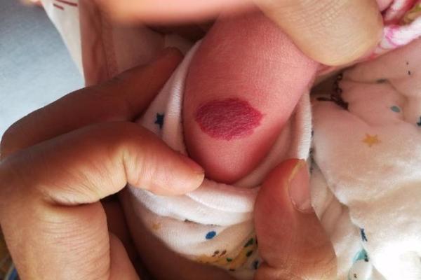 胎记的位置与运势算命