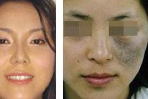 如何根据背部胎记算命-