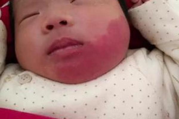 红色胎记算命 红色胎记算命