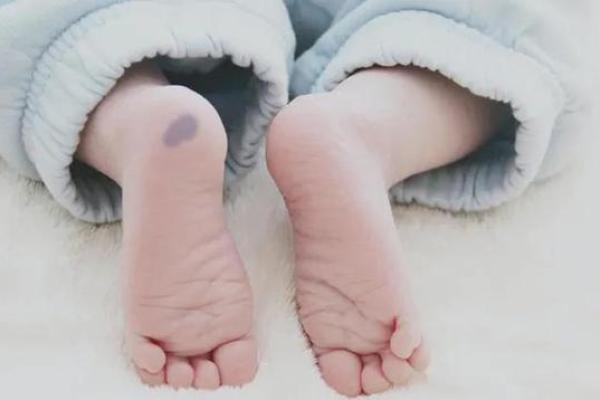 胎记算命：如何看胎记算命